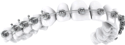 3 Discreet Options to Traditional Braces for Adults - Ascent Family Dental