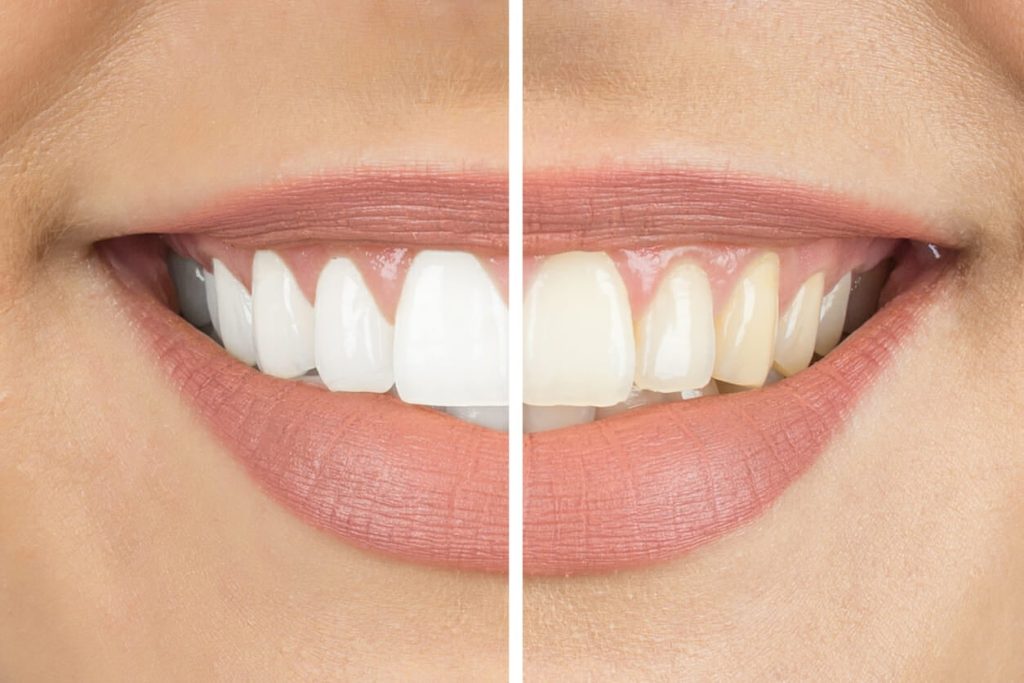 teeth whitening before and after