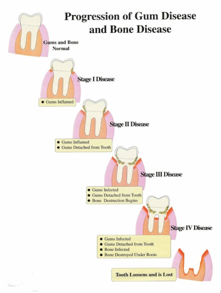 Dental Now Panorama Periodontal treatment