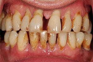 periodontal disease