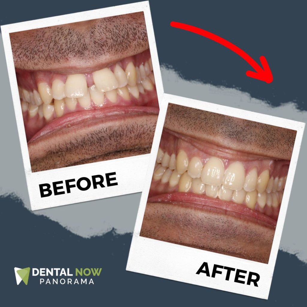 Before and After Dental Now Panorama 1