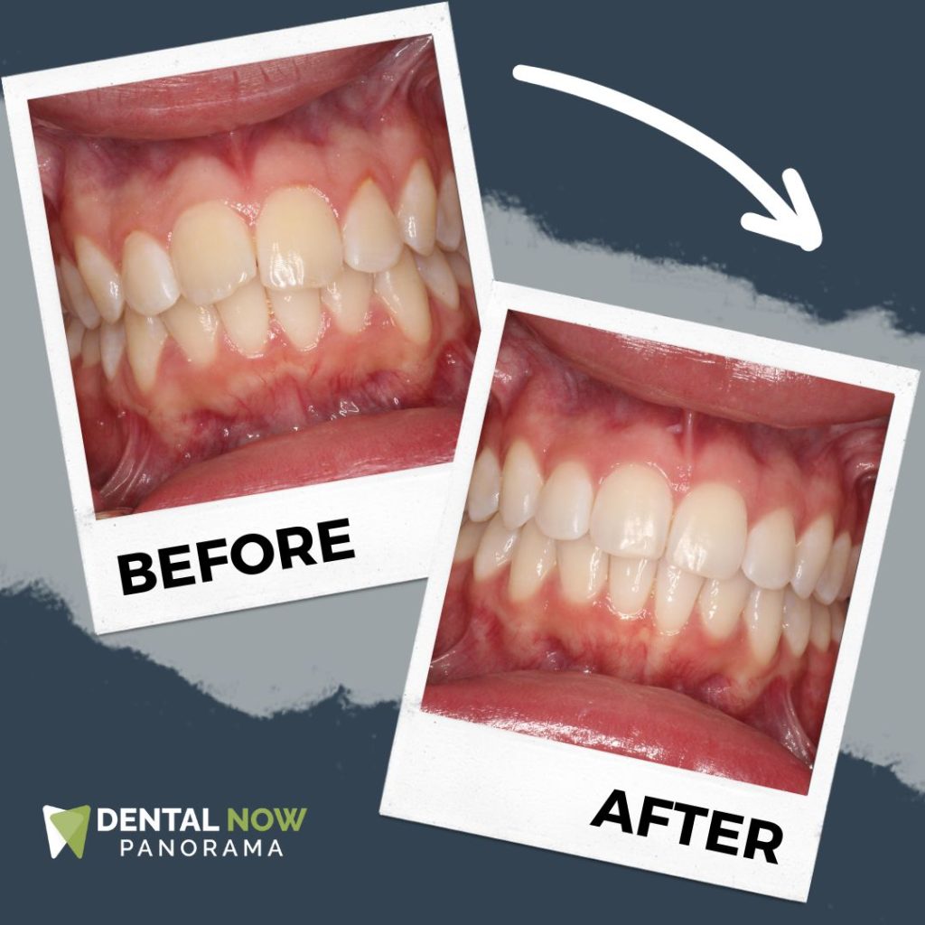Before and After Dental Now Panorama 10