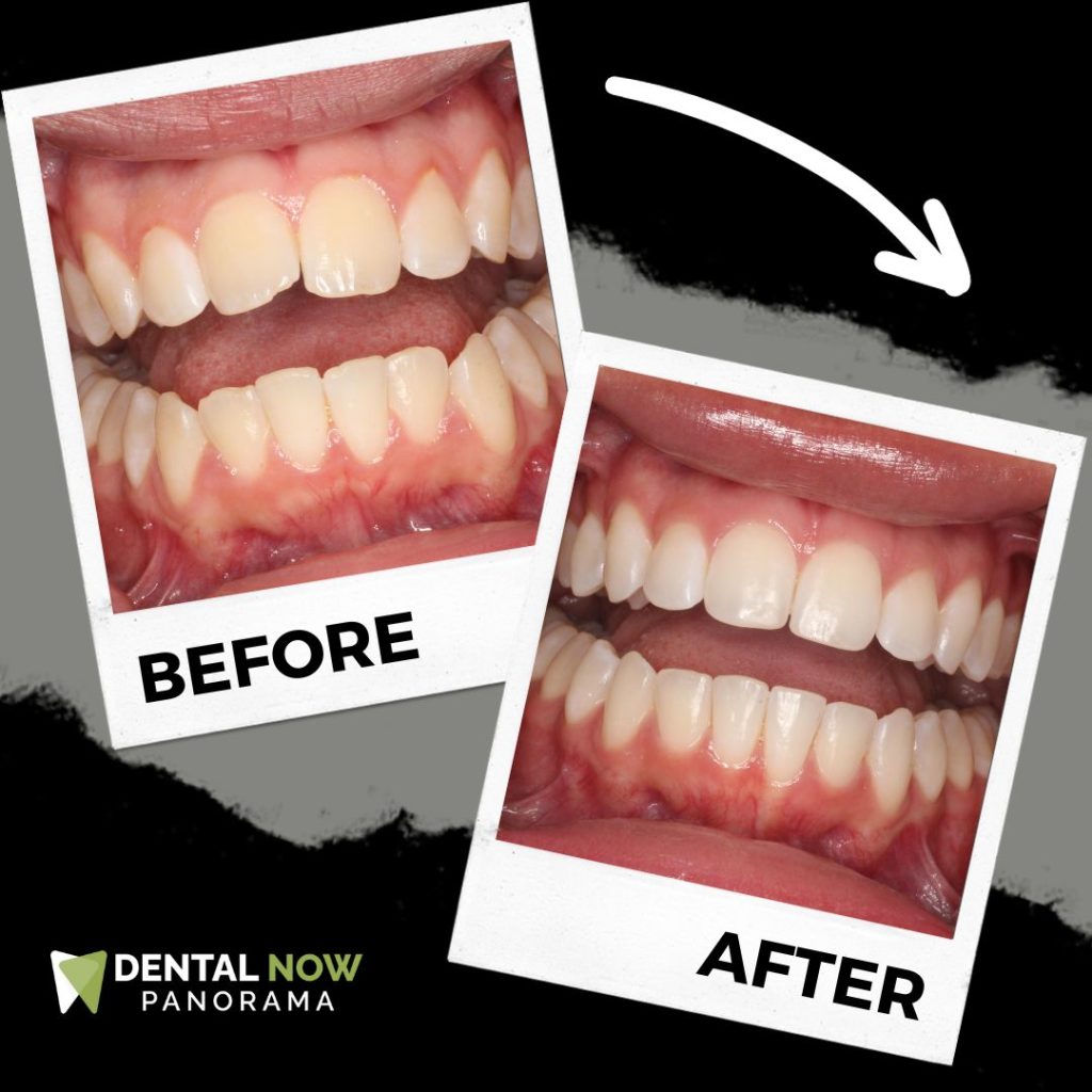 Before and After Dental Now Panorama 11