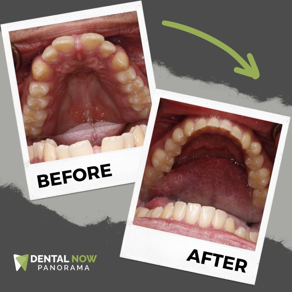 Before and After Dental Now Panorama 2