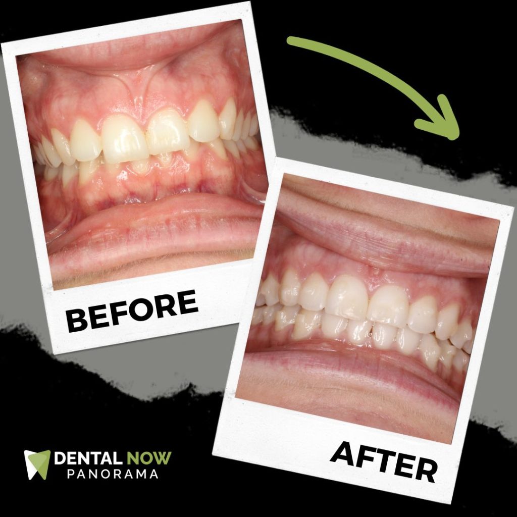 Before and After Dental Now Panorama 3