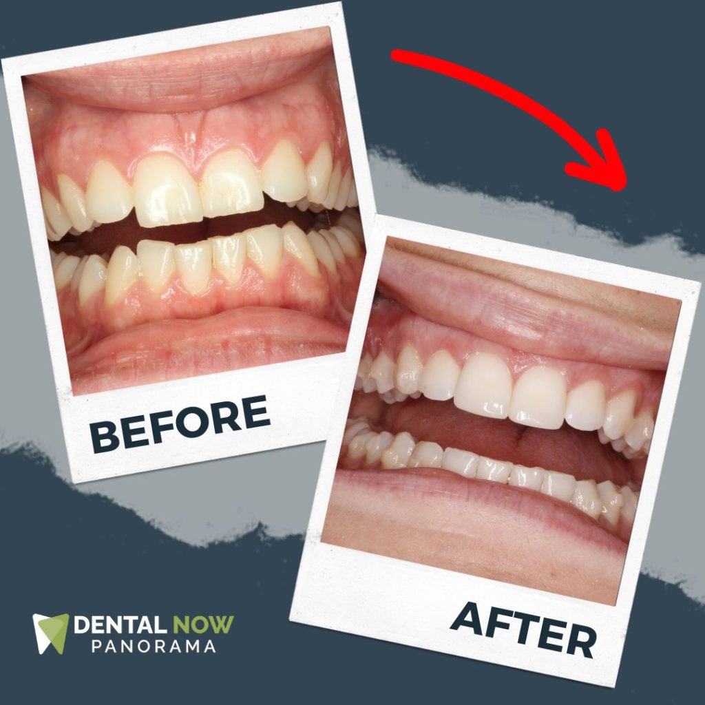 Before and After Dental Now Panorama 4