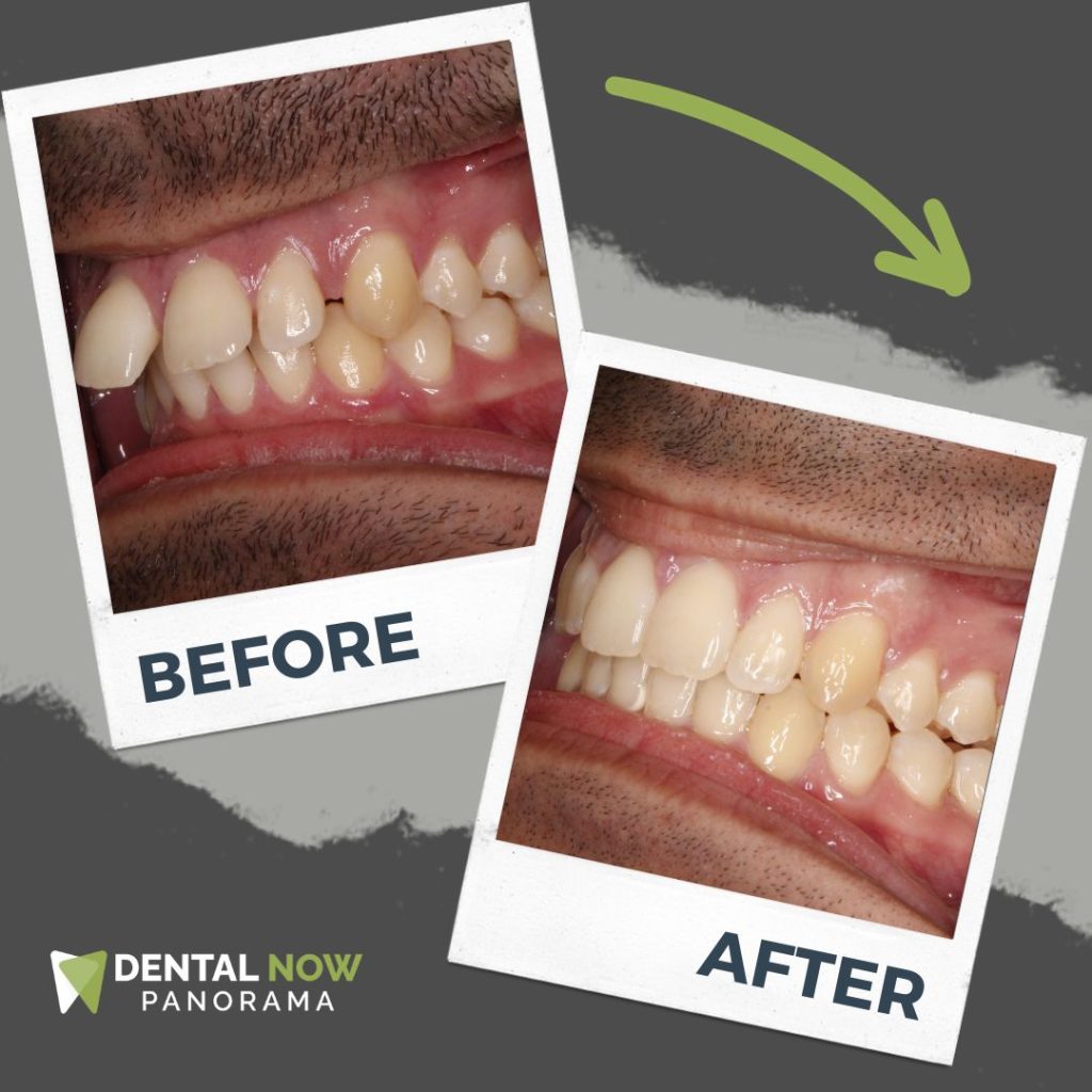 Before and After Dental Now Panorama 5