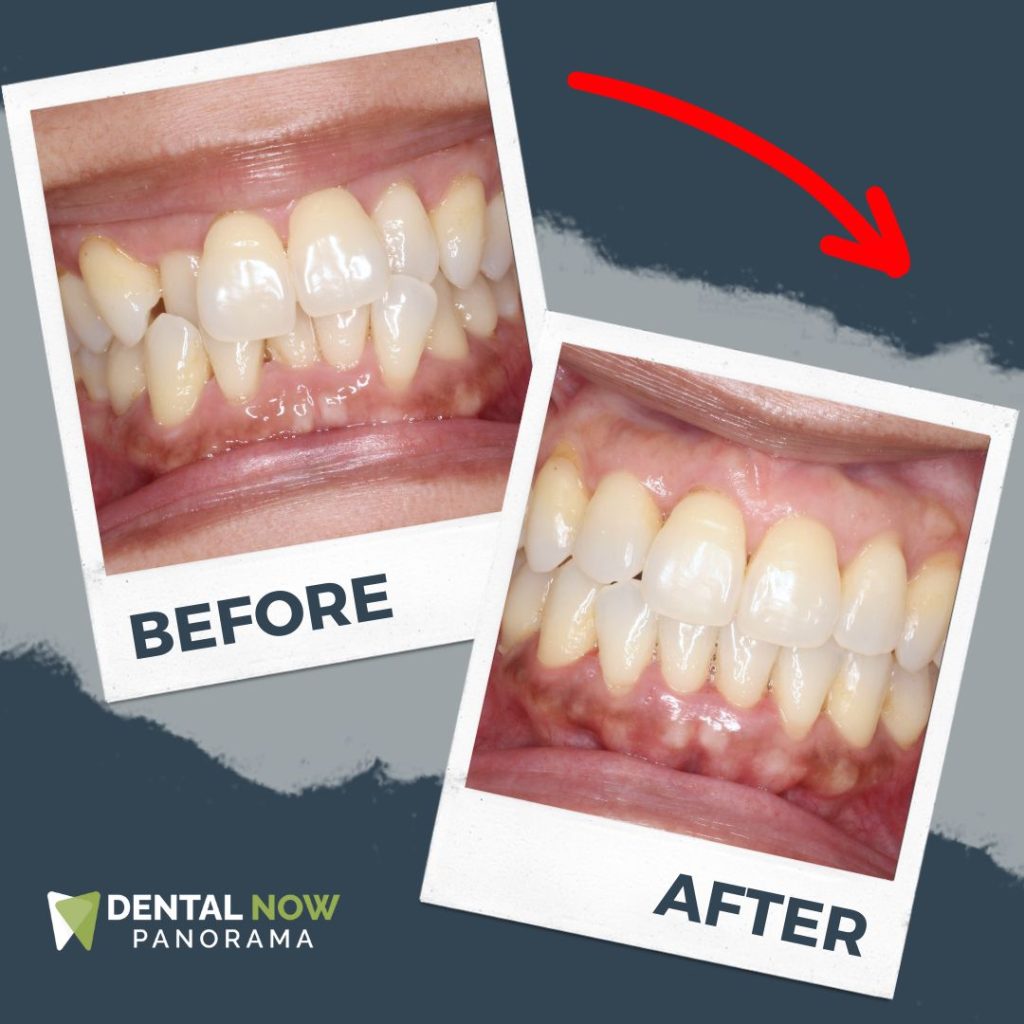 Before and After Dental Now Panorama 6