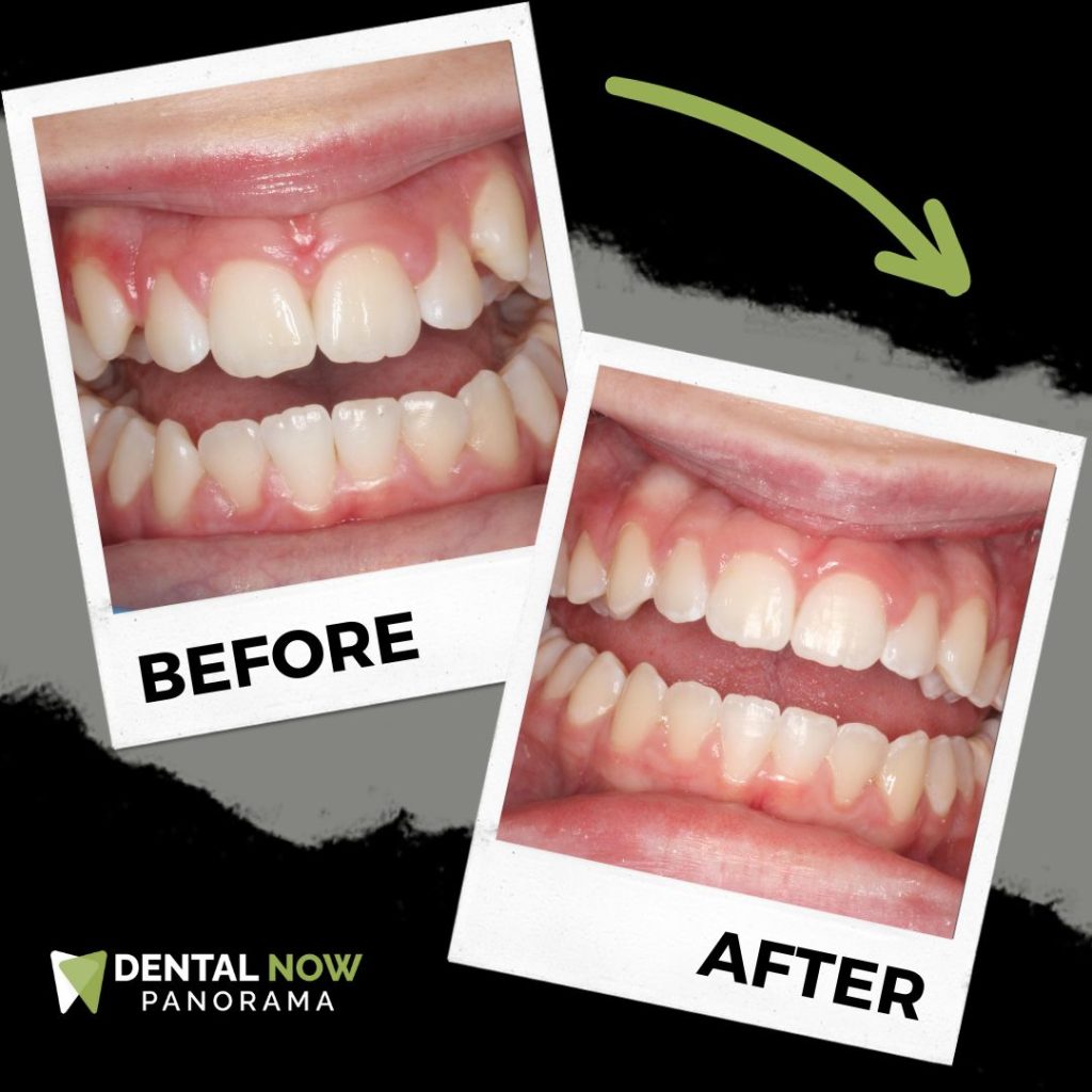 Before and After Dental Now Panorama 7