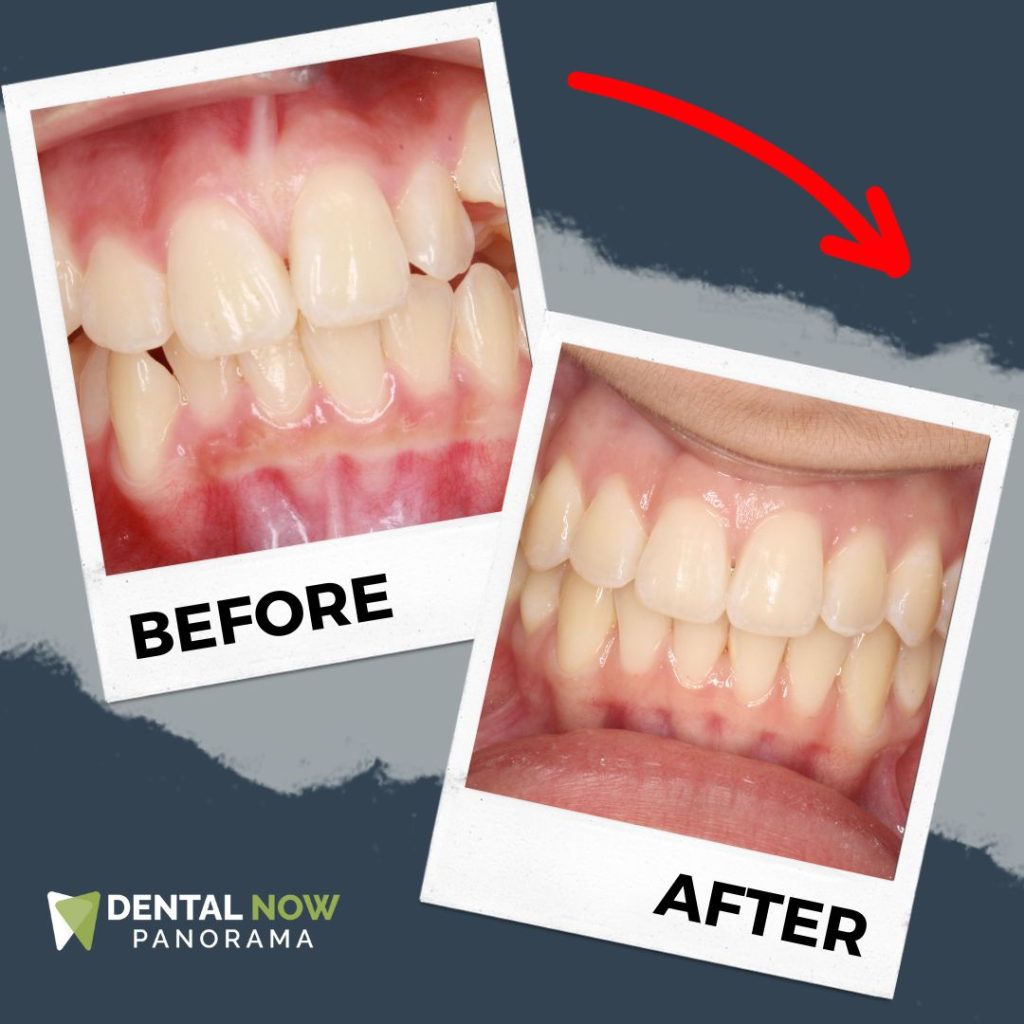 Before and After Dental Now Panorama 8