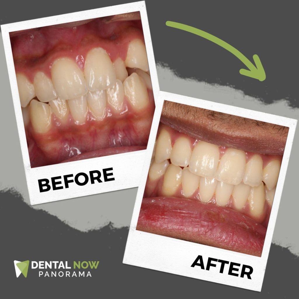 Before and After Dental Now Panorama 9