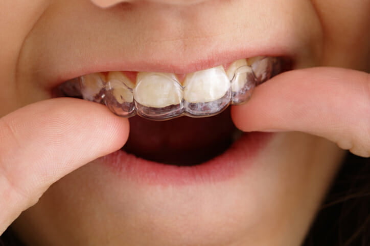 invisalign for kids for and teens